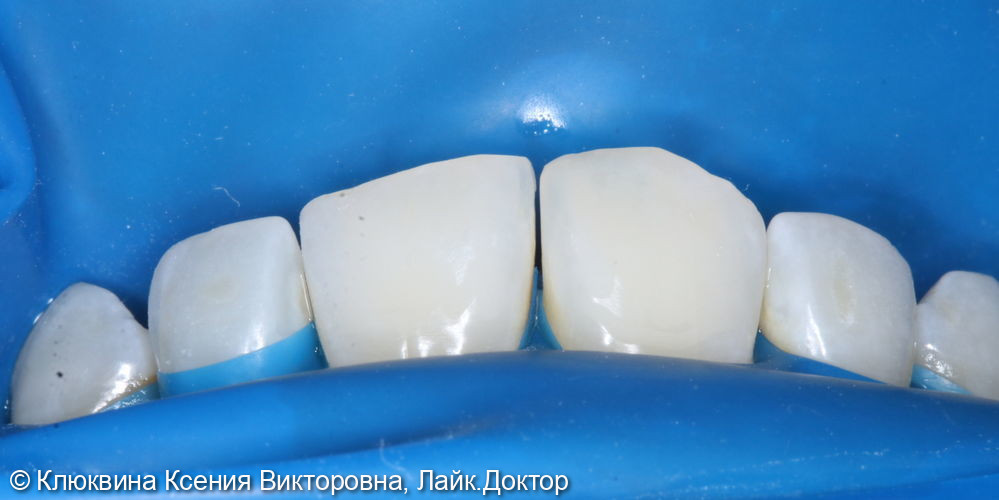 аддитивная реставрация фронтальной группы зубов - фото №1