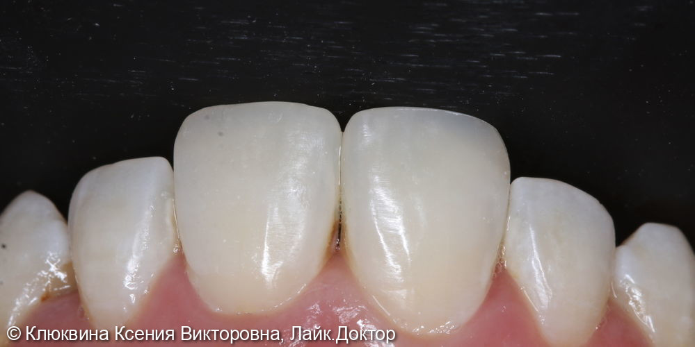 аддитивная реставрация фронтальной группы зубов - фото №3