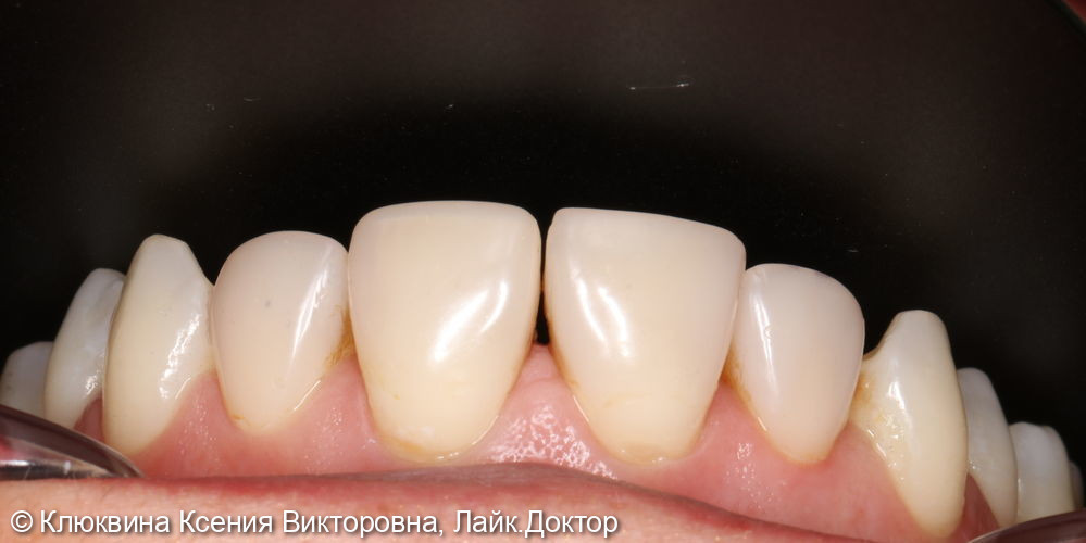 реставрация фронта с изменением формы и размеров зубов - фото №1
