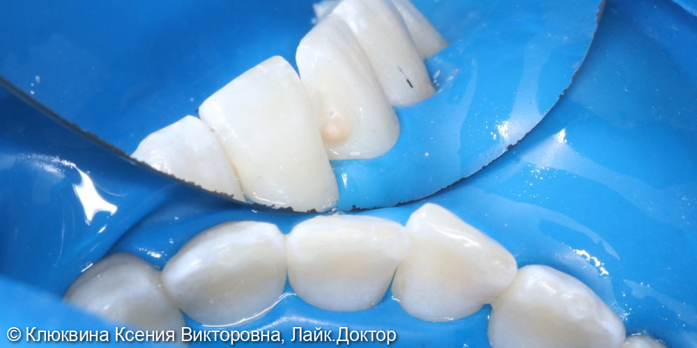 лечение кариеса 41 зуба, 31 ICON - фото №2