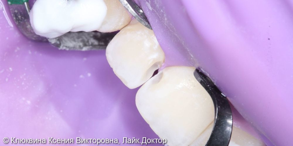 реставарция фронтальной группы зубов - фото №2