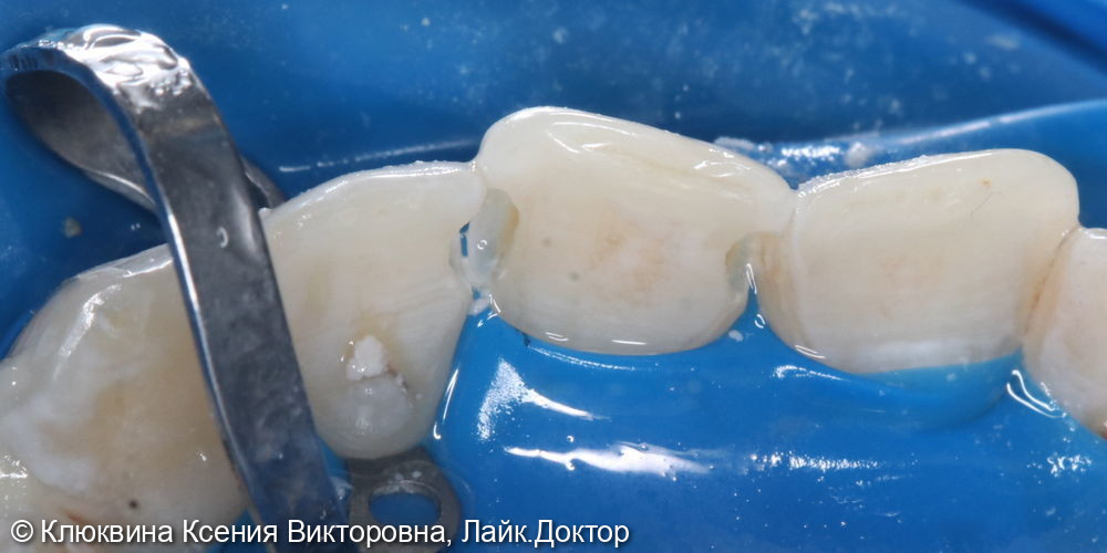 лечение кариеса фронтальной группы зубов - фото №3