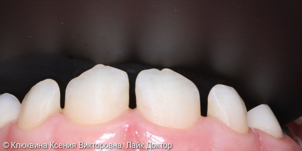 реставрация фронтальной группы зубов - фото №1