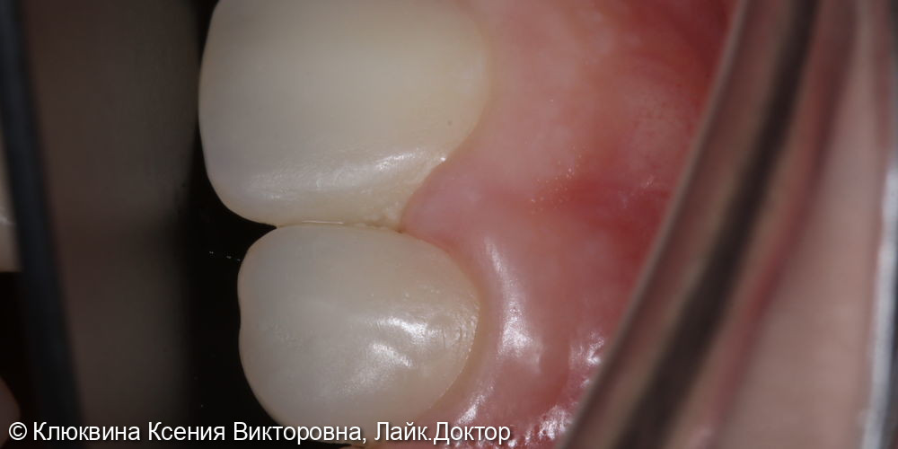 реставрация фронтальной группы зубов - фото №5