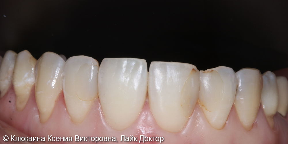 реставрация фронтальной группы зубов - фото №1