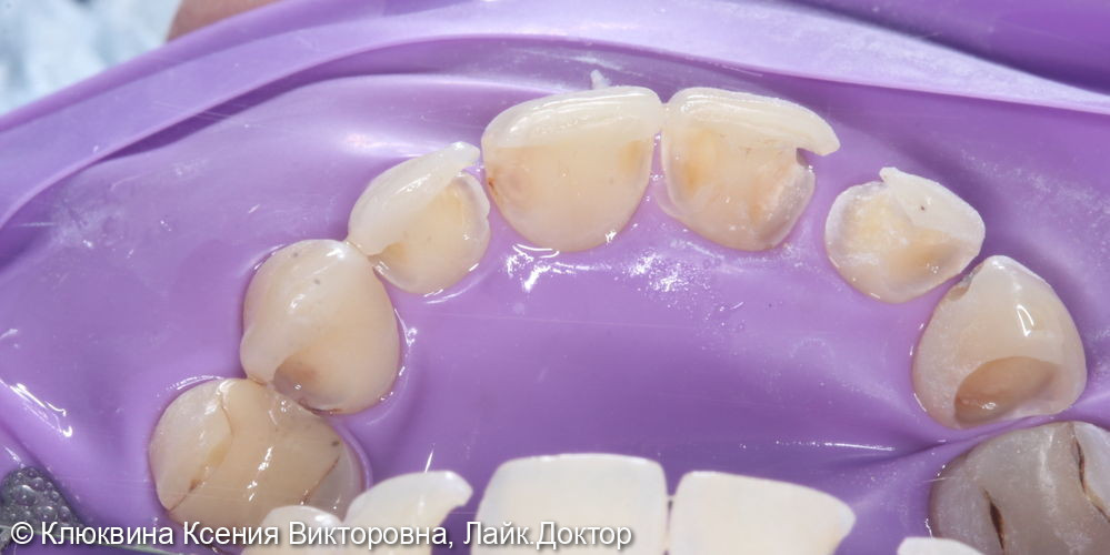 реставрация фронтальной группы зубов - фото №3