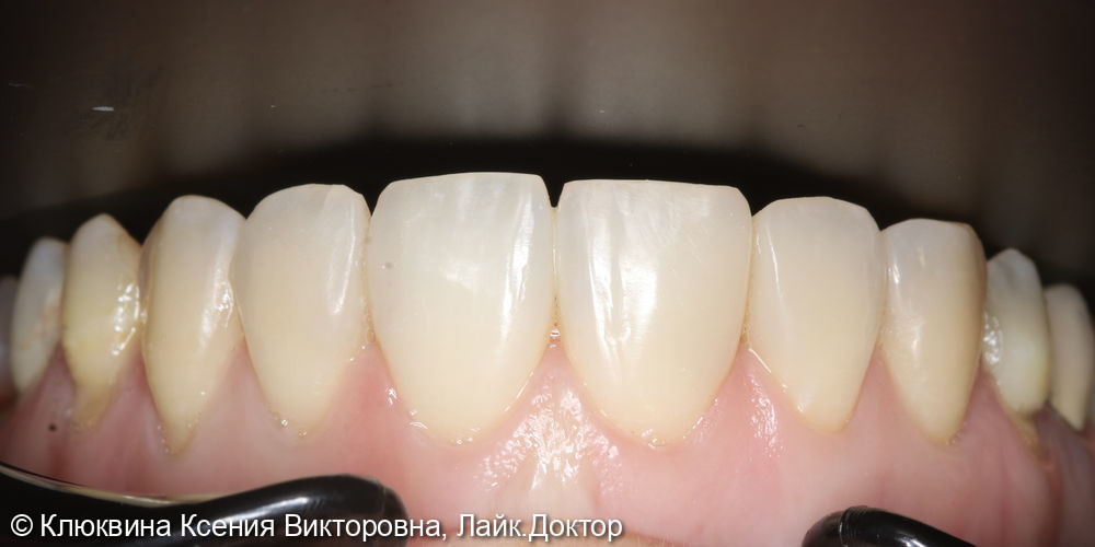 реставрация фронтальной группы зубов - фото №6