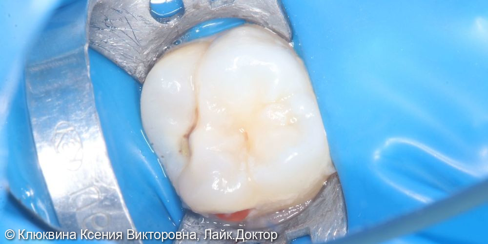 лечение кариеса зуба 16 - фото №1