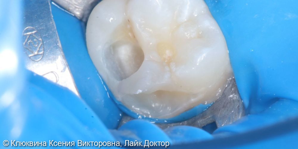лечение кариеса зуба 16 - фото №4
