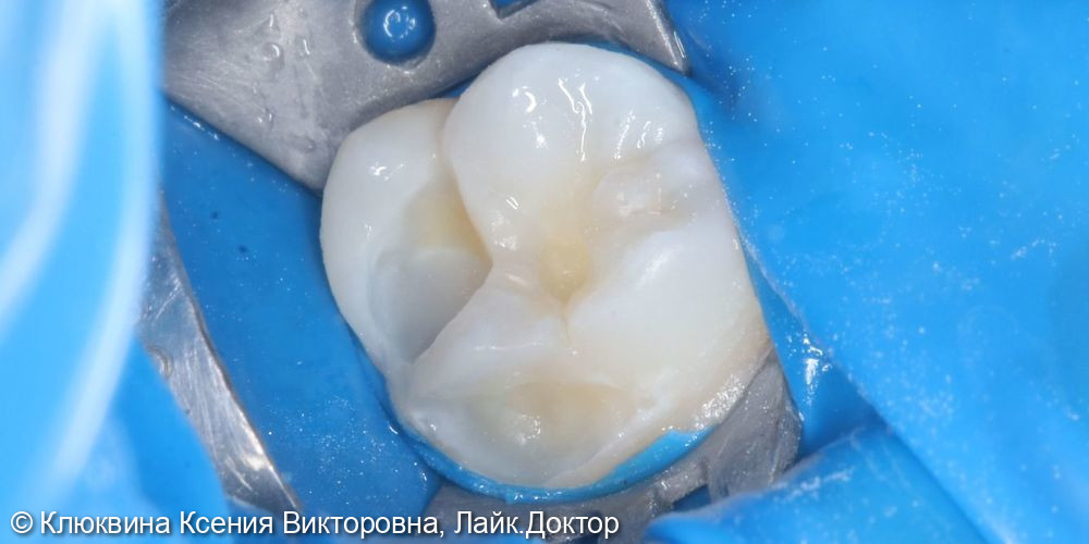 лечение кариеса зуба 16 - фото №5