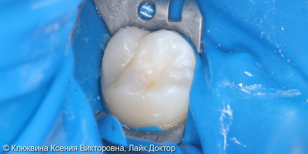 лечение кариеса зуба 16 - фото №6