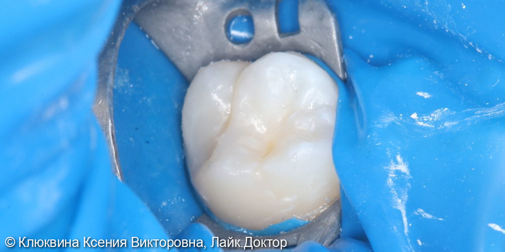 лечение кариеса зуба 16 - фото №7