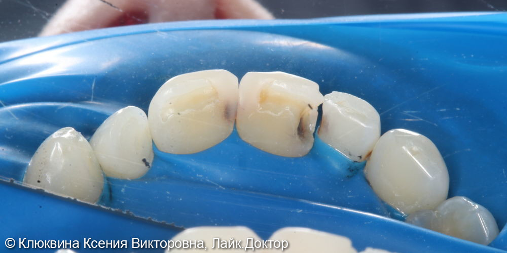 лечение кариеса фронтальной группы зубов - фото №1