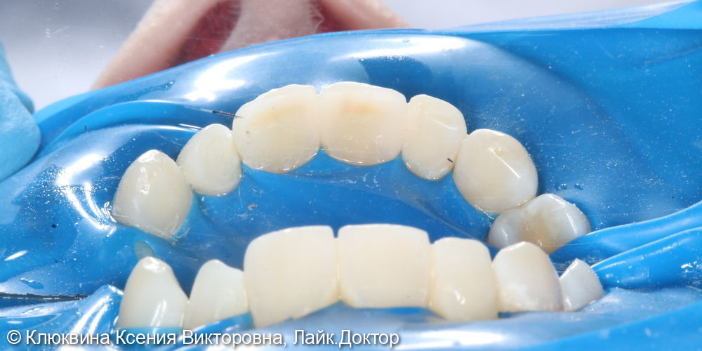 лечение кариеса фронтальной группы зубов - фото №4