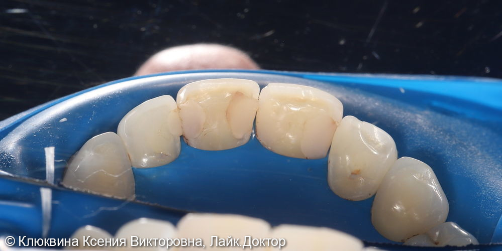 лечение кариеса фронтальной группы зубов - фото №1