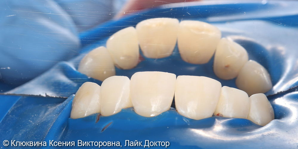 лечение кариеса фронтальной группы зубов - фото №6