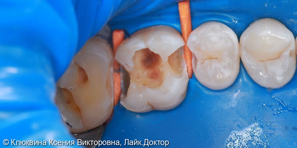 лечение кариеса фото 2 · Вологда