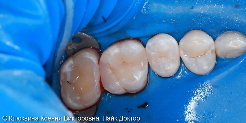 лечение кариеса фото 3 · Вологда