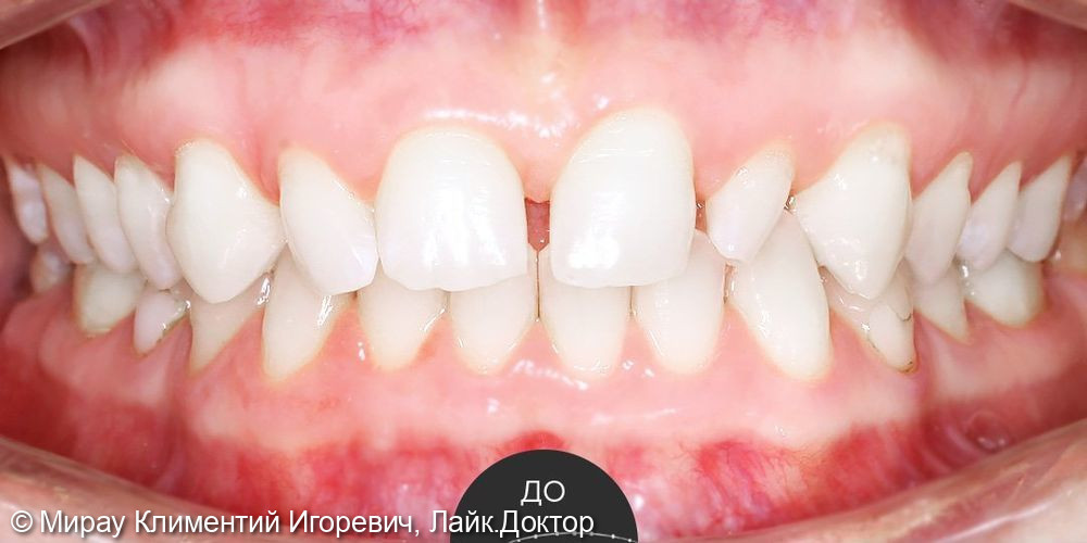 Виниры е-мах на 6 верхних зубов в области улыбки - фото №1