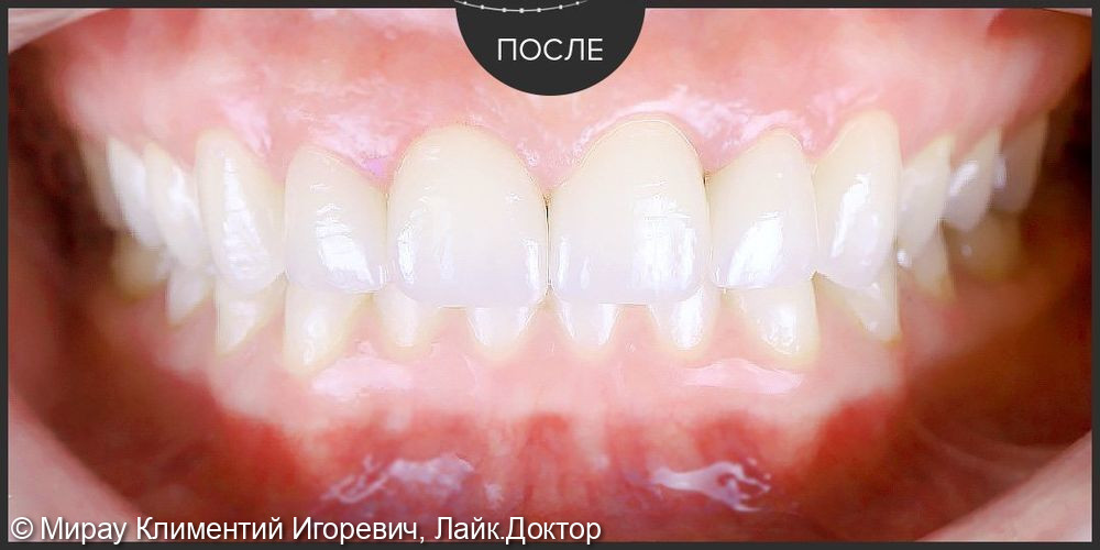 Виниры е-мах на 6 верхних зубов в области улыбки - фото №2