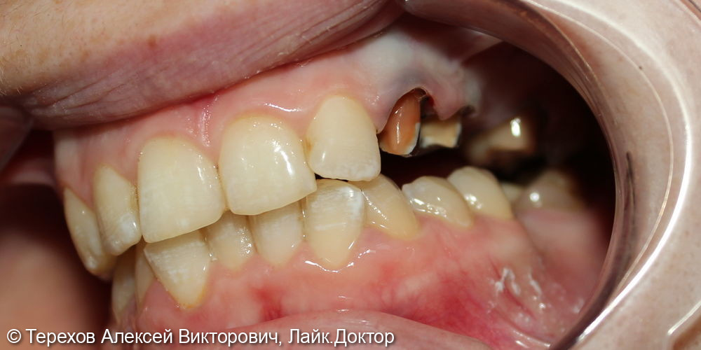 Протезирование с опорой на свои зубы - фото №1