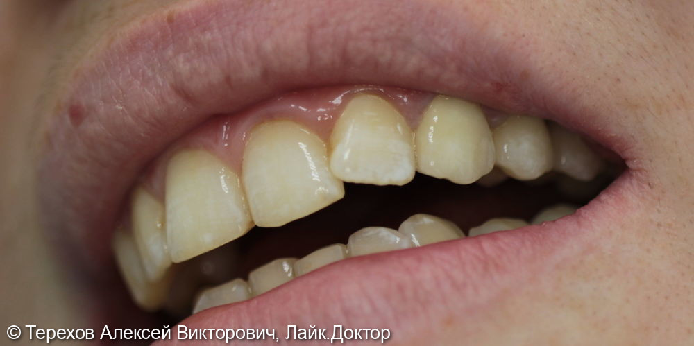 Протезирование с опорой на свои зубы - фото №2