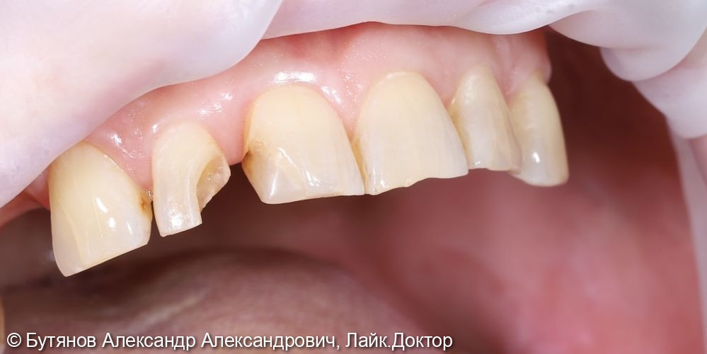 Лечение глубокого кариеса 1.2 зуба - фото №1