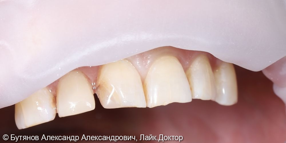 Лечение глубокого кариеса 1.2 зуба - фото №2