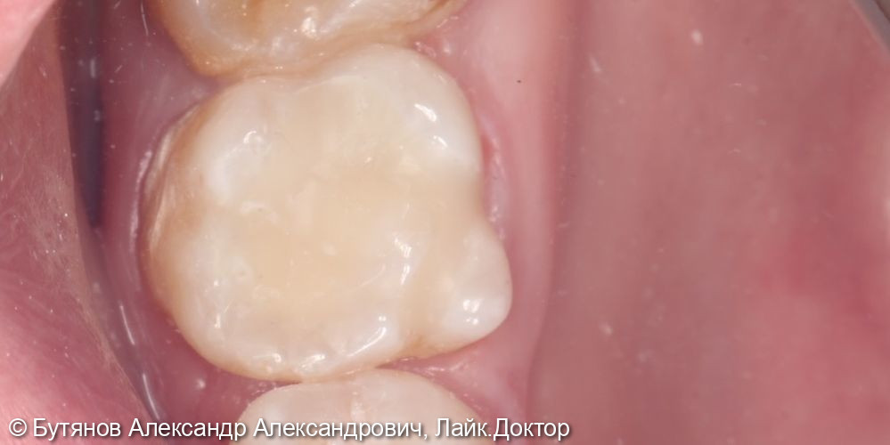 Лечение глубокого кариеса 4.6 зуба - фото №3