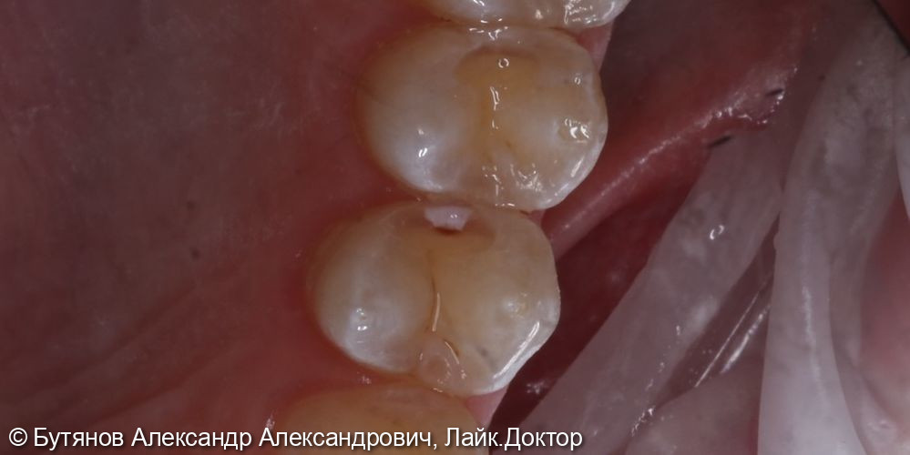 Средний кариес 2.4 и 2.5 - фото №2