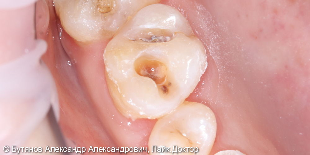 Лечение глубокого кариеса 1.6 - фото №2
