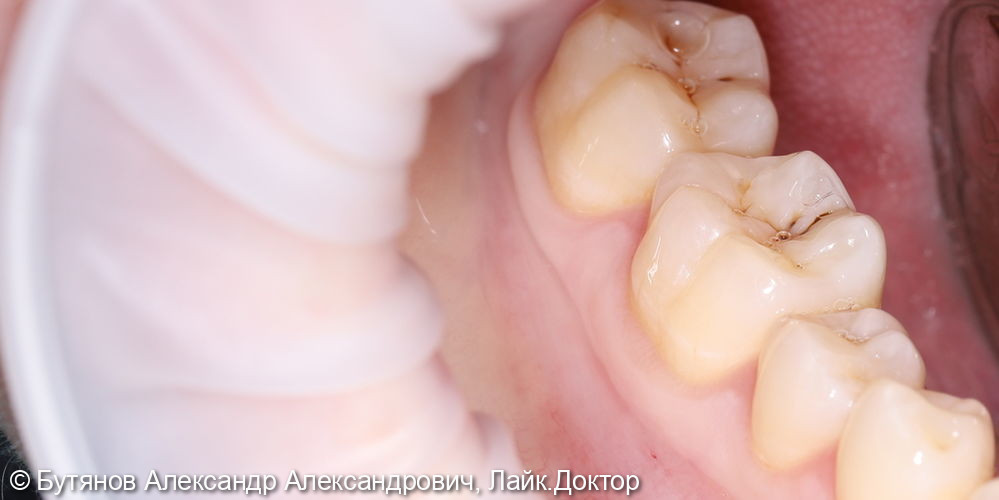 Лечение кариеса жевательного зуба 4.6 - фото №1
