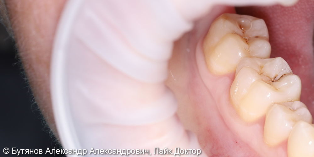 Лечение кариеса жевательного зуба 4.6 - фото №1