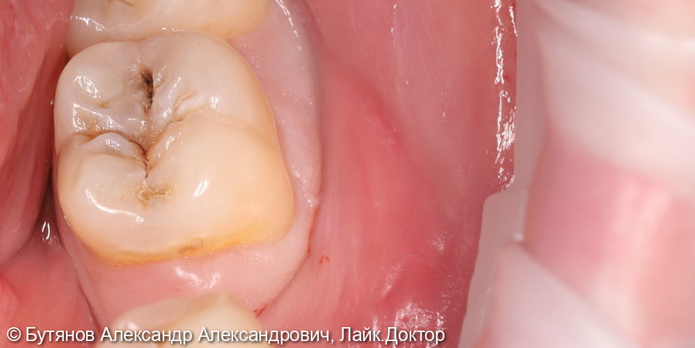 Лечение глубокого кариеса 3.7 зуба - фото №1