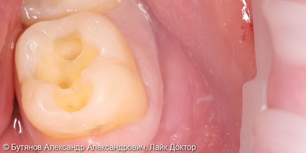 Лечение глубокого кариеса 3.7 зуба - фото №3