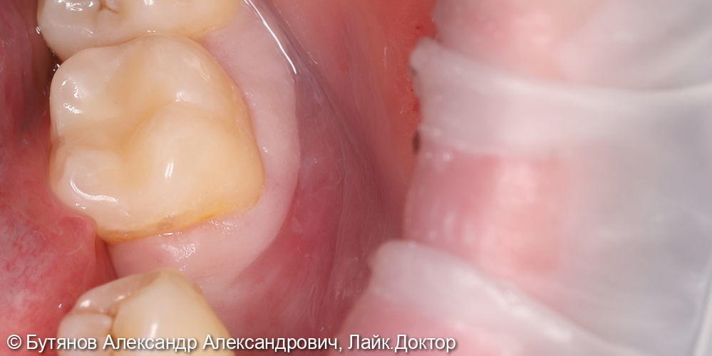Лечение глубокого кариеса 3.7 зуба - фото №4