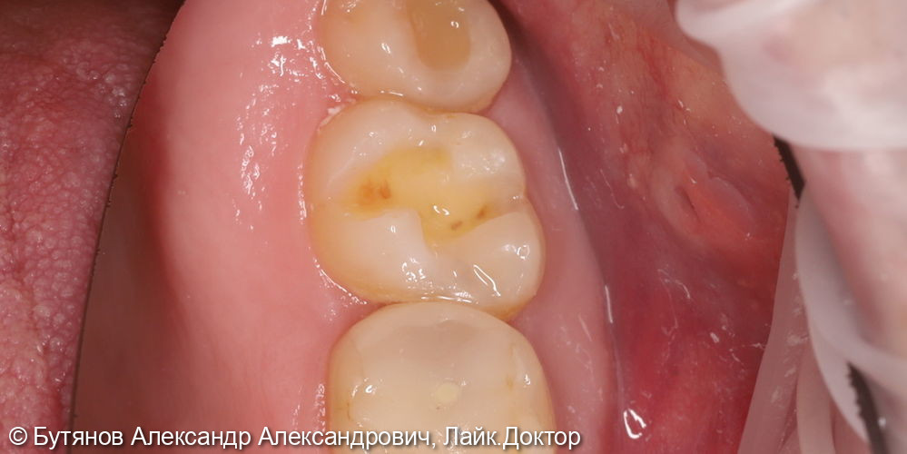 Лечение глубокого кариеса зуба 3.7 - фото №2