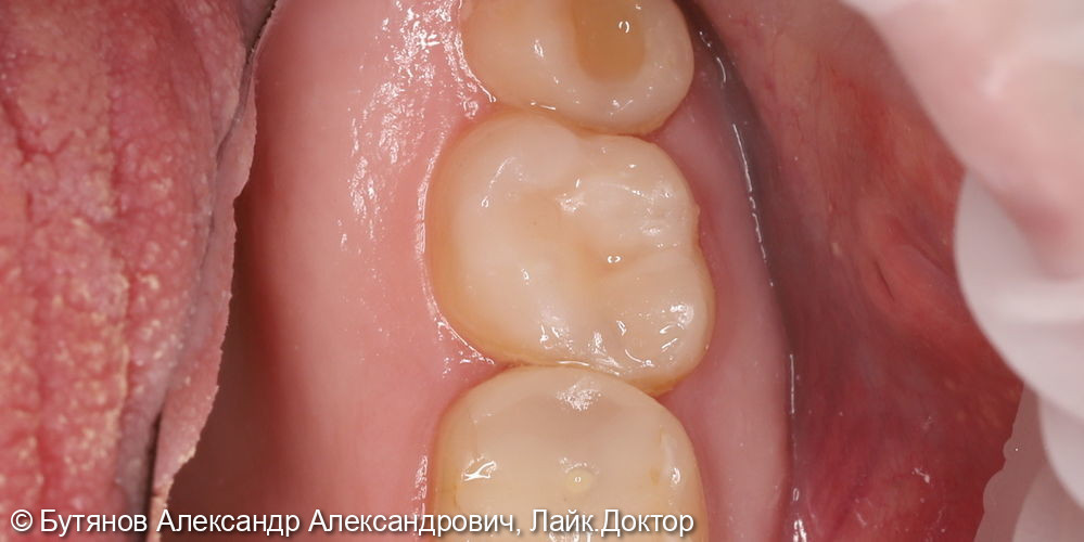 Лечение глубокого кариеса зуба 3.7 - фото №3