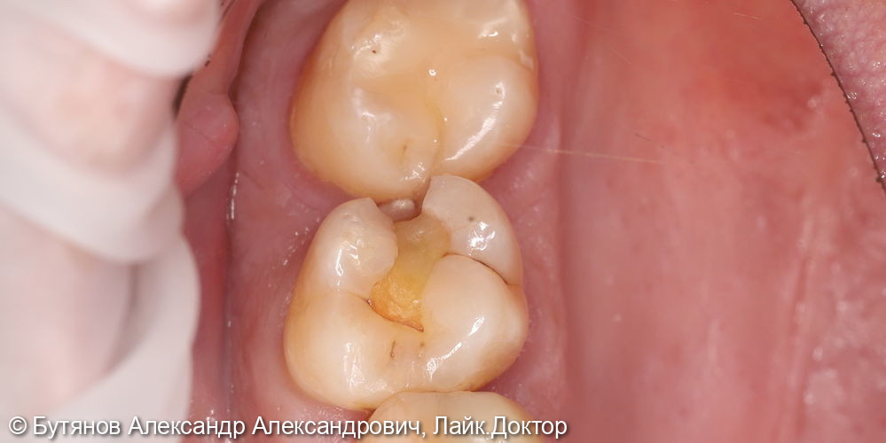 Лечение глубокого кариеса зуба 1.6 - фото №1
