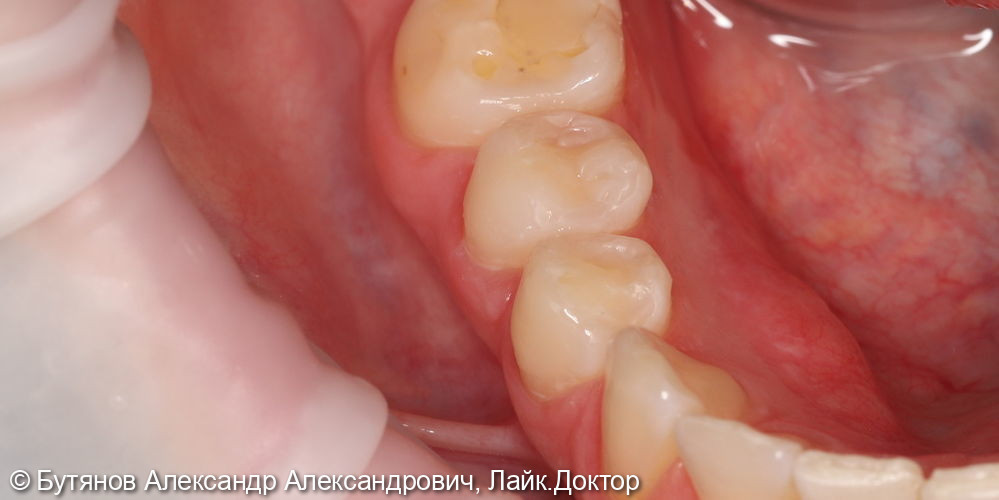 Лечение глубокого кариеса 4.5 зуба - фото №4