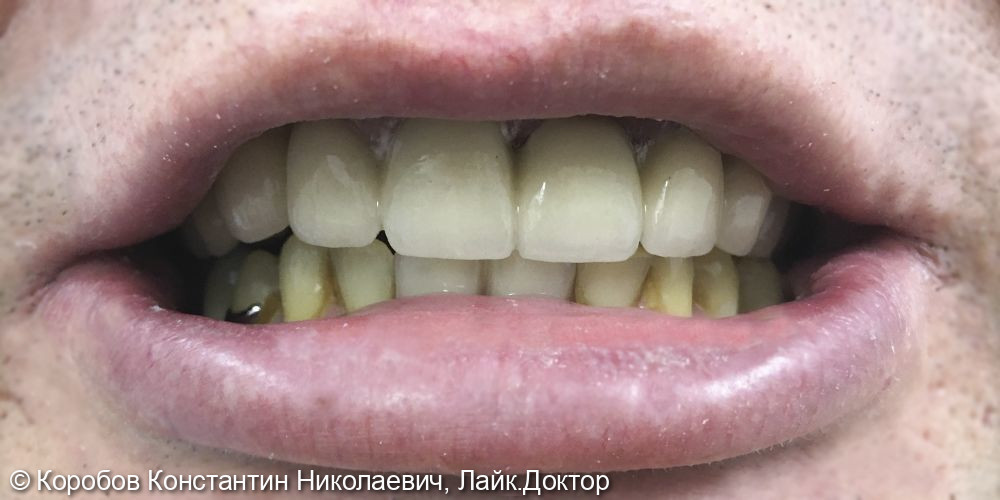 Протезирование зубов - фото №2