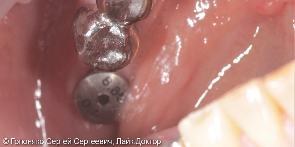 Коронка на импланте 46 зуб - фото №1