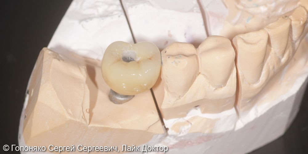 Коронка на импланте 46 зуб - фото №2