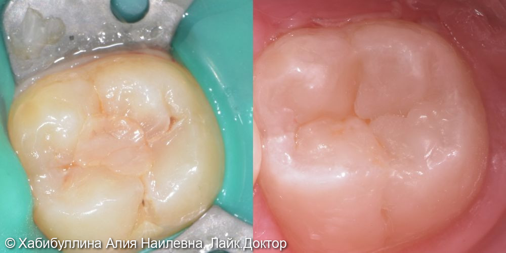 Лечение вторичного кариеса зуба 47 - фото №1
