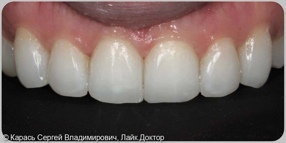 Реставрация фронтальной группы зубов - фото №2
