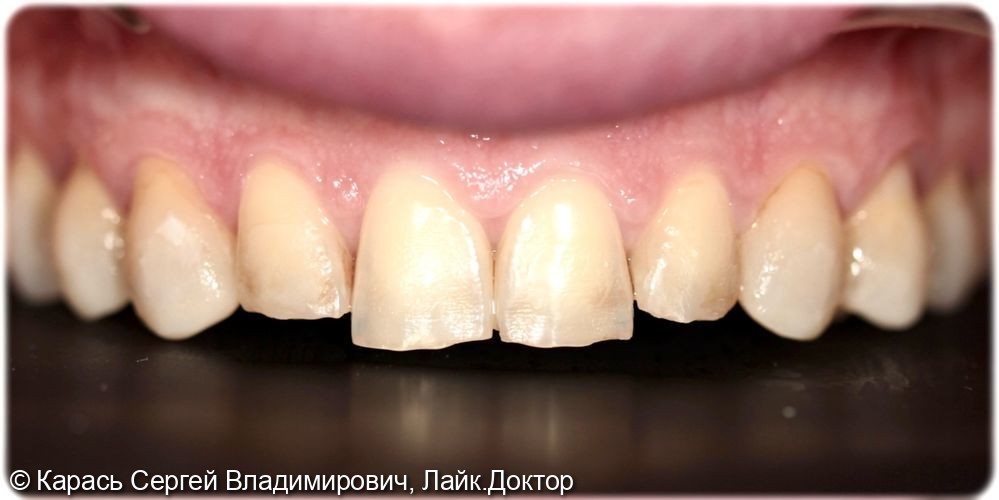 Реставрация фронтальной группы зубов - фото №1