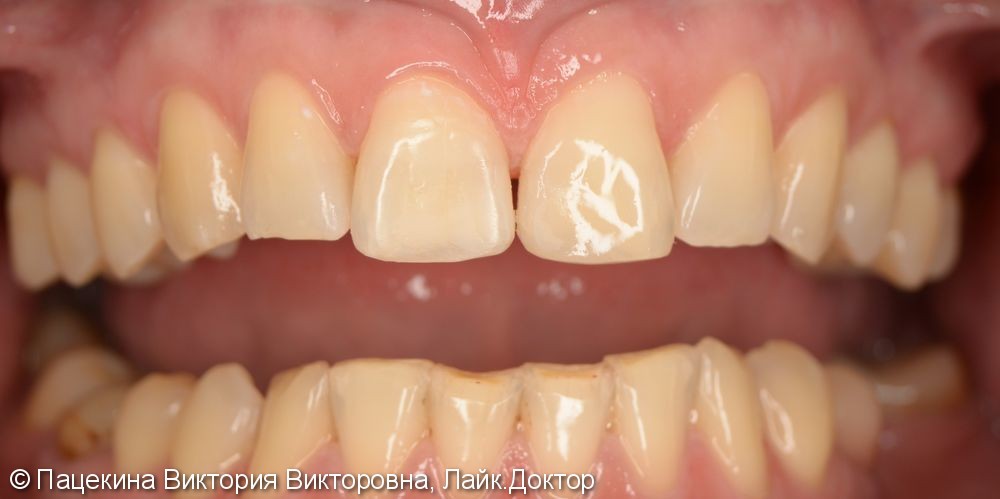 Фото лечения детских зубов до и после thumbnail