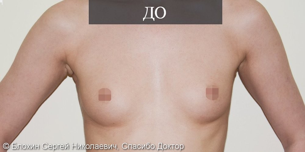 Результаты эндоскопического увеличения груди, фото до/после - фото №1