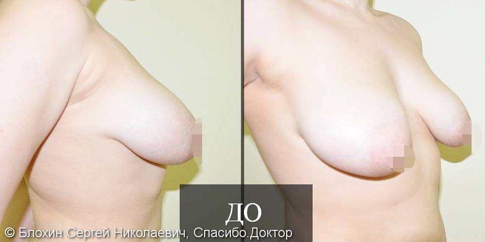 Подтяжка груди с увеличением, фото до и после - фото №1