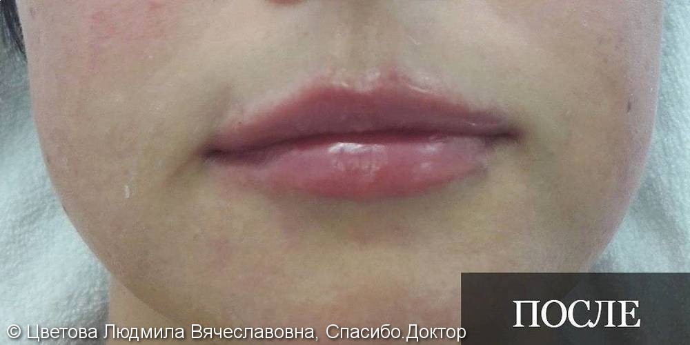 Коррекция ассиметрии губ с увеличением, фото до и после - фото №2